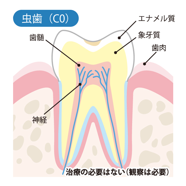 池袋の歯医者、サンシャインサイド太田歯科で虫歯治療