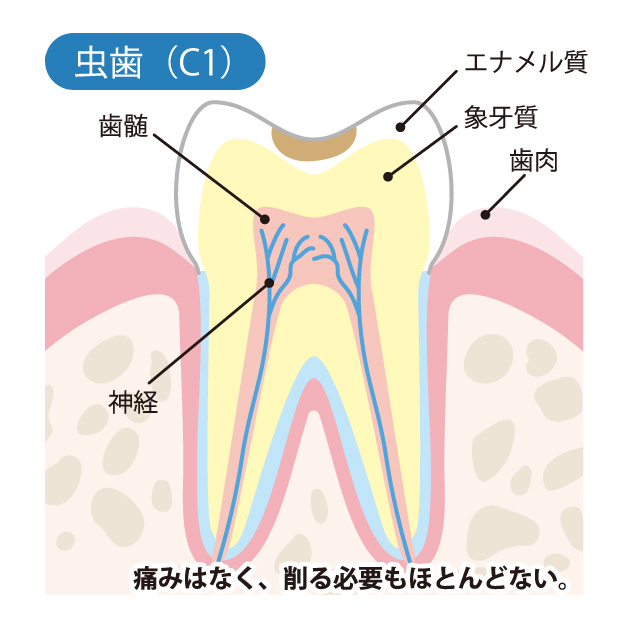 池袋の歯医者、サンシャインサイド太田歯科で虫歯治療