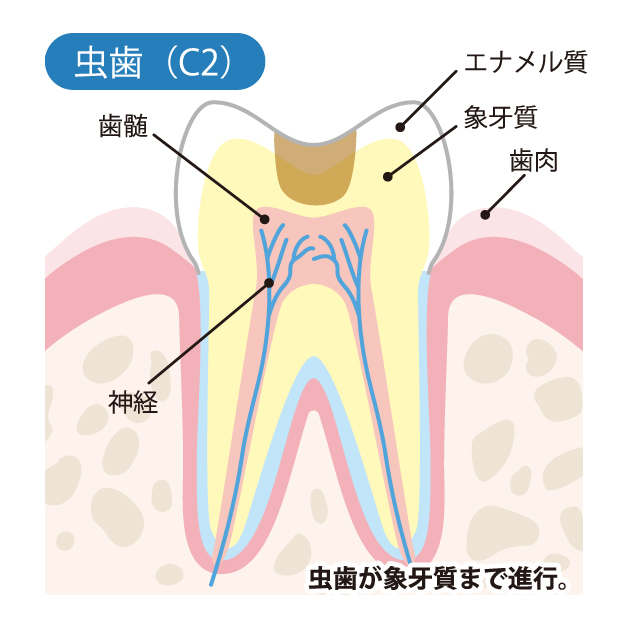 池袋の歯医者、サンシャインサイド太田歯科で虫歯治療