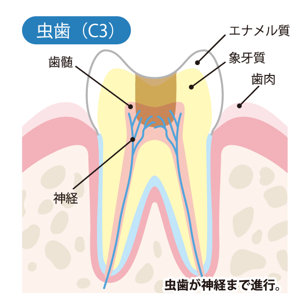 池袋の歯医者、サンシャインサイド太田歯科で虫歯治療