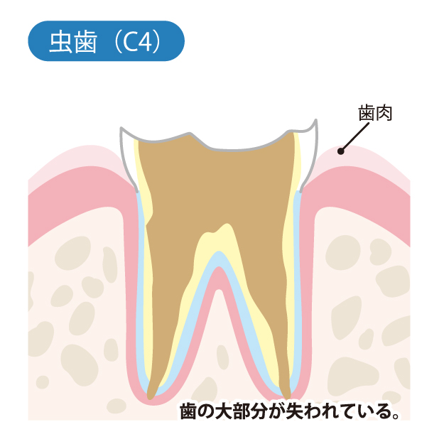 虫歯治療