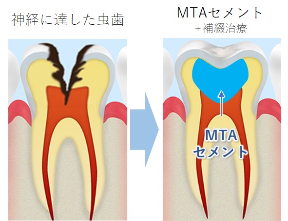 池袋の歯医者、サンシャインサイド太田歯科のMTAセメント