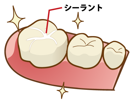 池袋の歯医者、サンシャインサイド太田歯科でシーラント